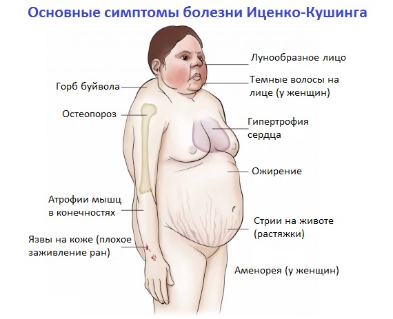 Симптомы синдрома Иценко-Кушинга