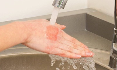 Первая помощь: что делать, если обжег руку горячей водой