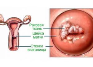Причины и лечение инвазивного рака шейки матки