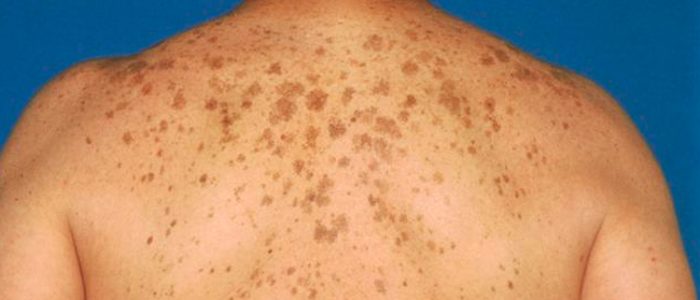 Симптомы и лечение меланомы кожи