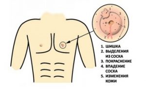 Симптомы и лечение рака груди у мужчин
