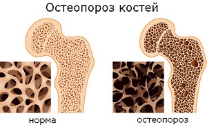 Остеопороз костей