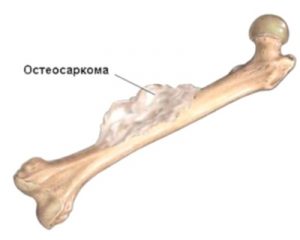 Онкология костного мозга
