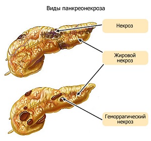 Виды панкреонекроза