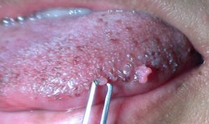 Предраковые заболевания полости рта