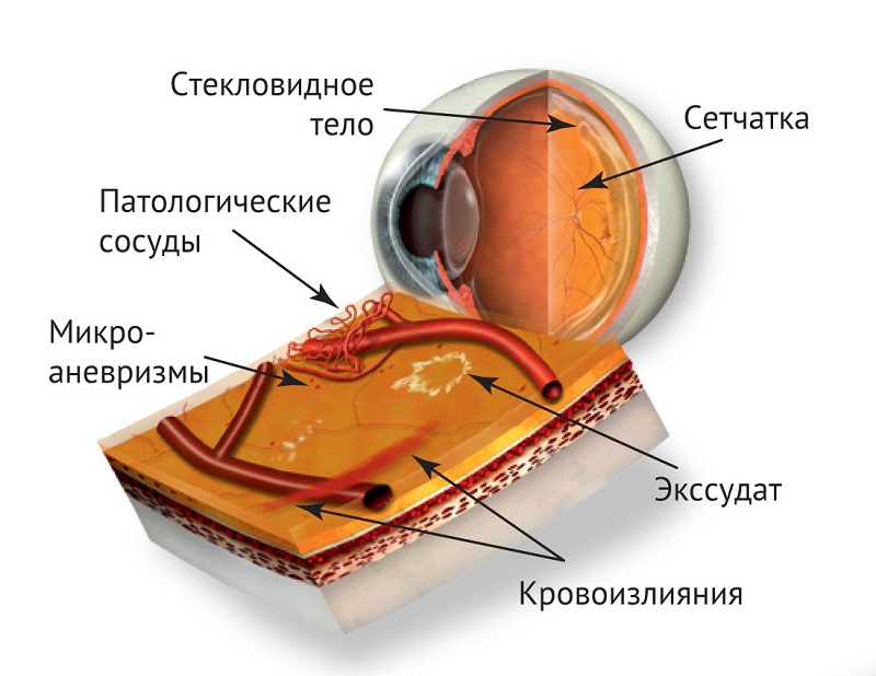 Патология глаза