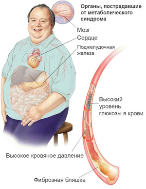 Последствия ожирения