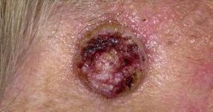 Симптомы и лечение меланомы кожи