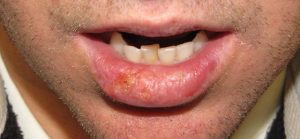 Симптомы и лечение рака губы