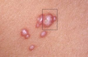 Симптомы и лечение рака кожи