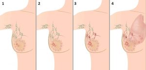 1 стадия рака молочной железы