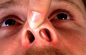 Онкология носа