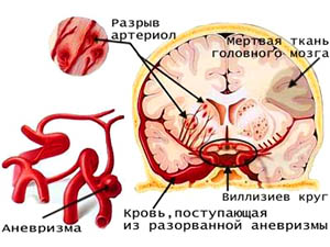 Схема повреждения мозга