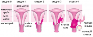 Симптомы и лечение рака шейки матки