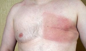Симптомы и лечение рака груди у мужчин