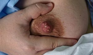 Рак груди на УЗИ