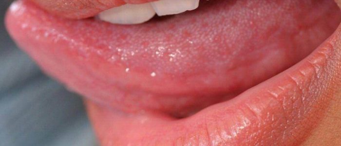 Симптомы и лечение рака языка